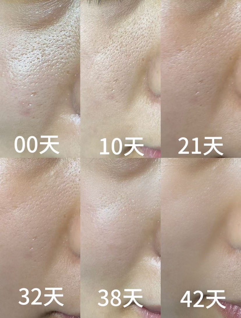 毛孔粗大細緻課程