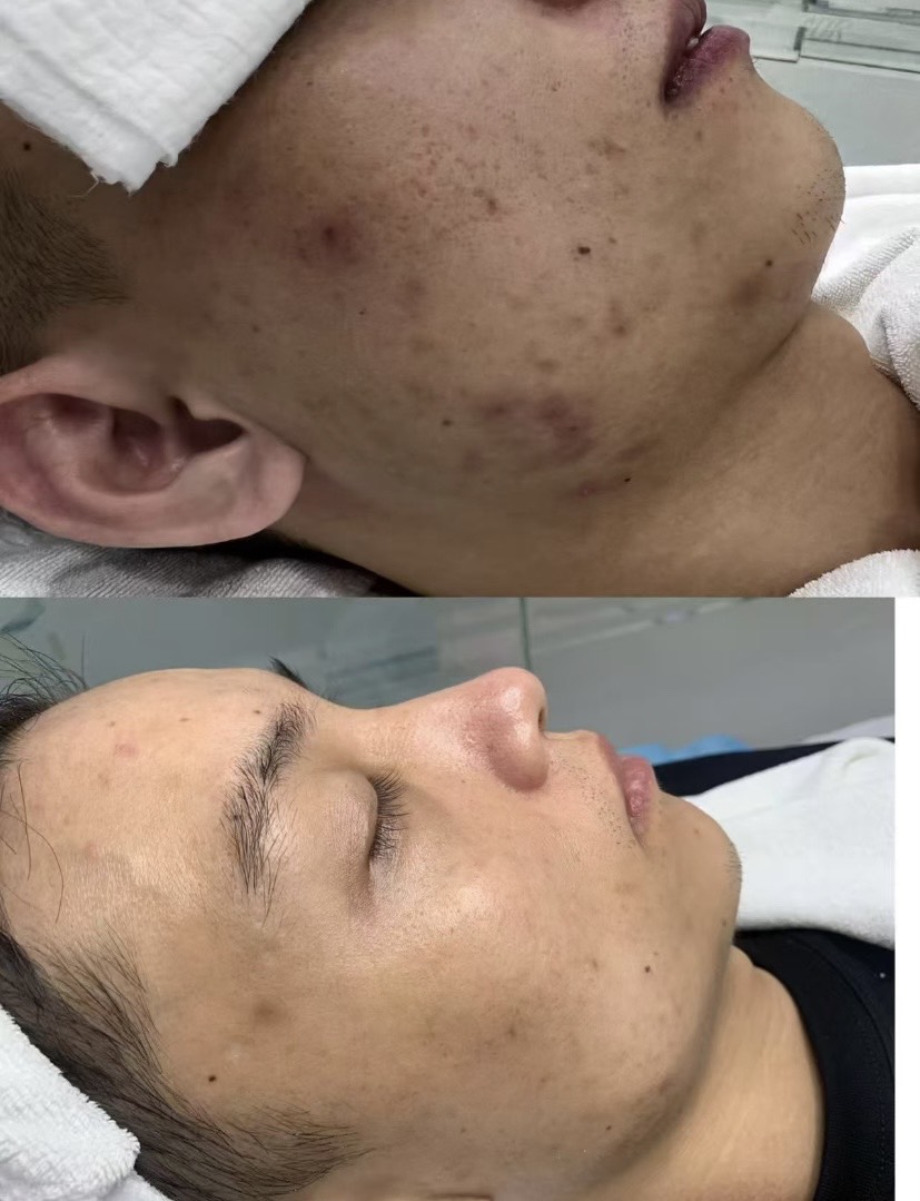 男生做臉後整體膚質感受